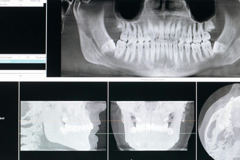 gomulu dis cerrahisi icin cekilmis x ray